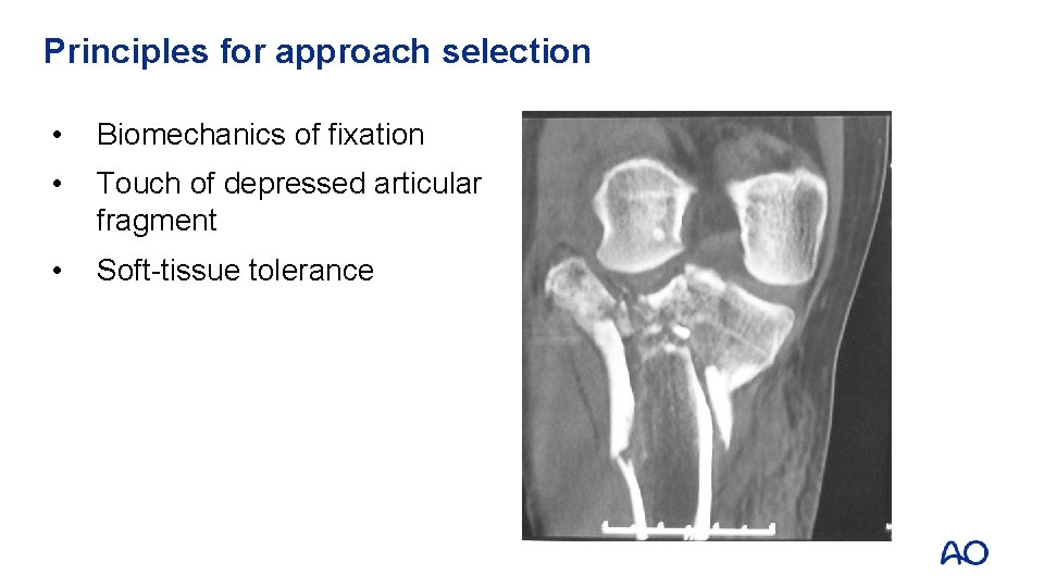 Principles for approach selection • Biomechanics of fixation • Touch of depressed articular fragment