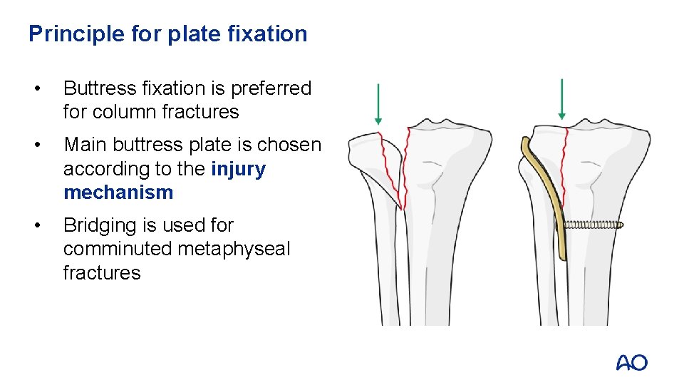 Principle for plate fixation • Buttress fixation is preferred for column fractures • Main