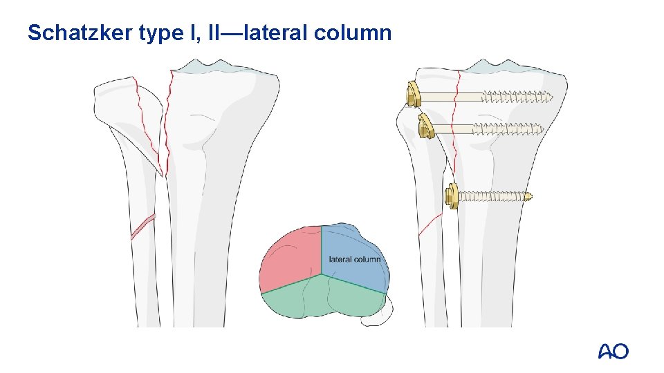 Schatzker type I, II—lateral column 