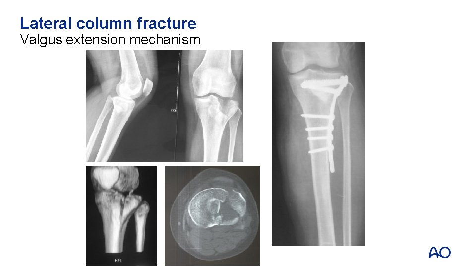 Lateral column fracture Valgus extension mechanism 