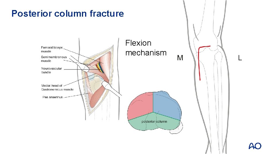 Posterior column fracture Flexion mechanism M L 