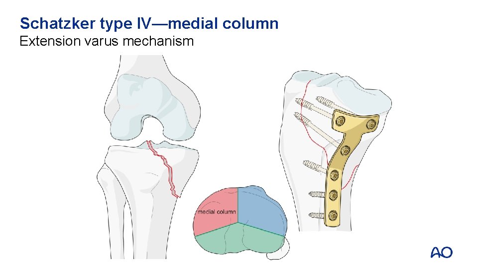 Schatzker type IV—medial column Extension varus mechanism 