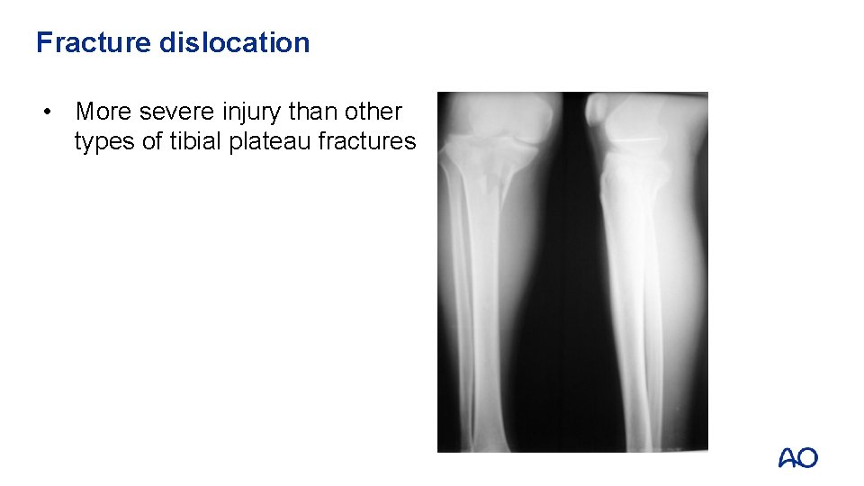 Fracture dislocation • More severe injury than other types of tibial plateau fractures 
