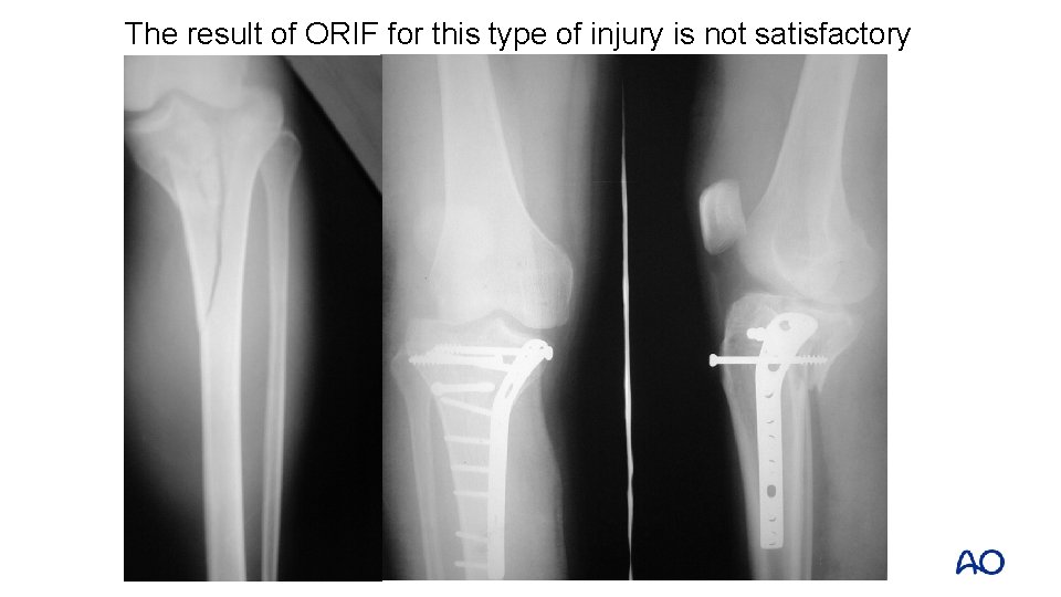 The result of ORIF for this type of injury is not satisfactory 