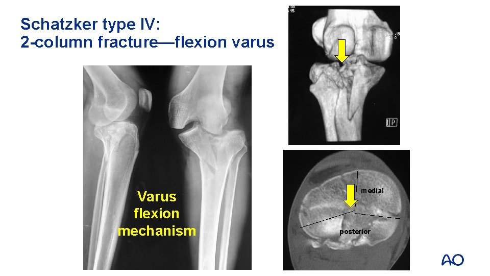 Schatzker type IV: 2 -column fracture—flexion varus Varus flexion mechanism medial posterior 
