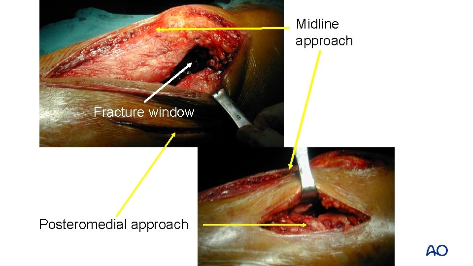 Midline approach Fracture window Posteromedial approach 