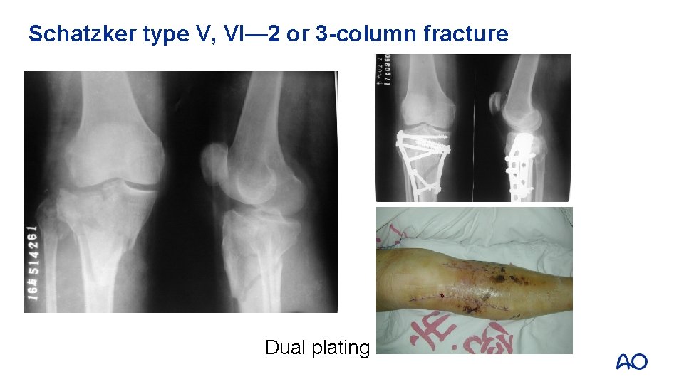 Schatzker type V, VI— 2 or 3 -column fracture Dual plating 