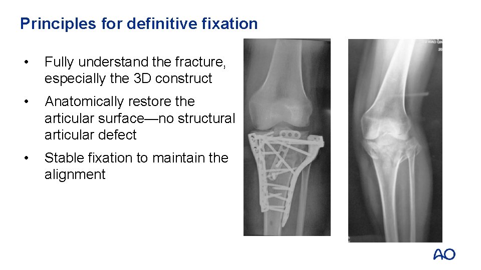 Principles for definitive fixation • Fully understand the fracture, especially the 3 D construct
