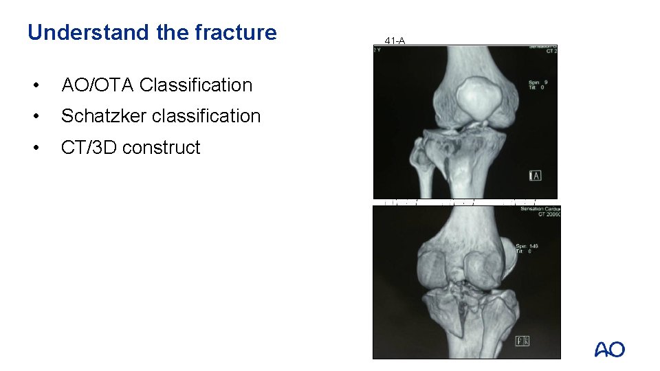 Understand the fracture • AO/OTA Classification • Schatzker classification • CT/3 D construct 41