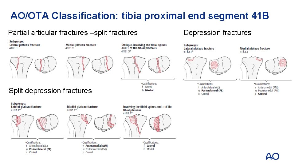 AO/OTA Classification: tibia proximal end segment 41 B Partial articular fractures –split fractures Split