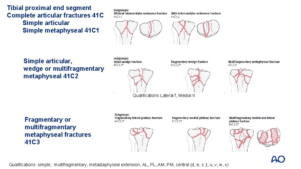 Tibial proximal end segment Complete articular fractures 41 C Simple articular Simple metaphyseal 41