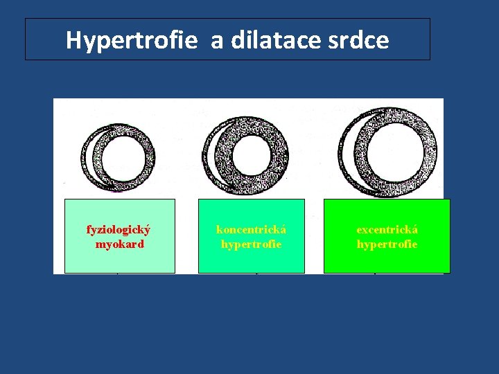 Hypertrofie a dilatace srdce fyziologický myokard koncentrická hypertrofie excentrická hypertrofie 