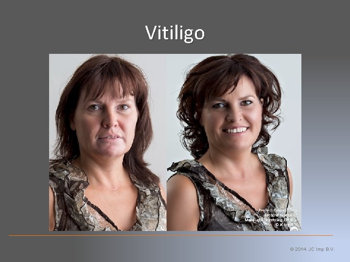 Vitiligo © 2014 JC Imp B. V. 