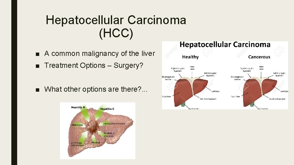 Hepatocellular Carcinoma (HCC) ■ A common malignancy of the liver ■ Treatment Options –