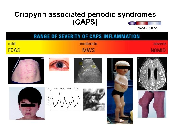 Criopyrin associated periodic syndromes (CAPS) 