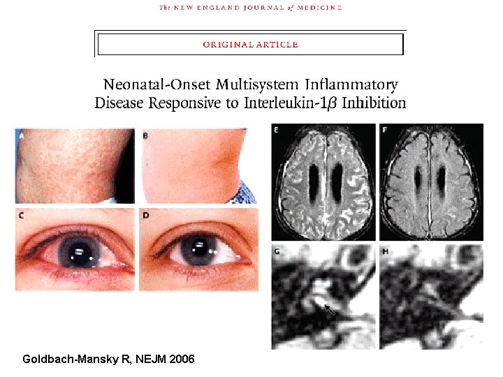 Goldbach-Mansky R, NEJM 2006 