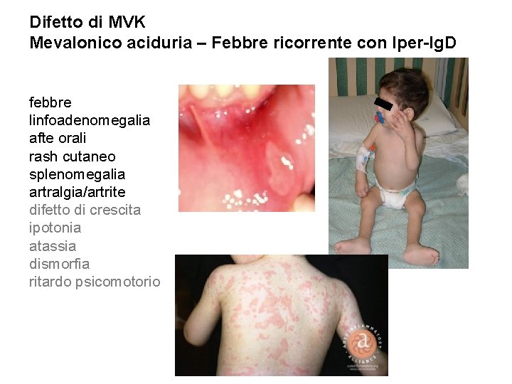 Difetto di MVK Mevalonico aciduria – Febbre ricorrente con Iper-Ig. D febbre linfoadenomegalia afte