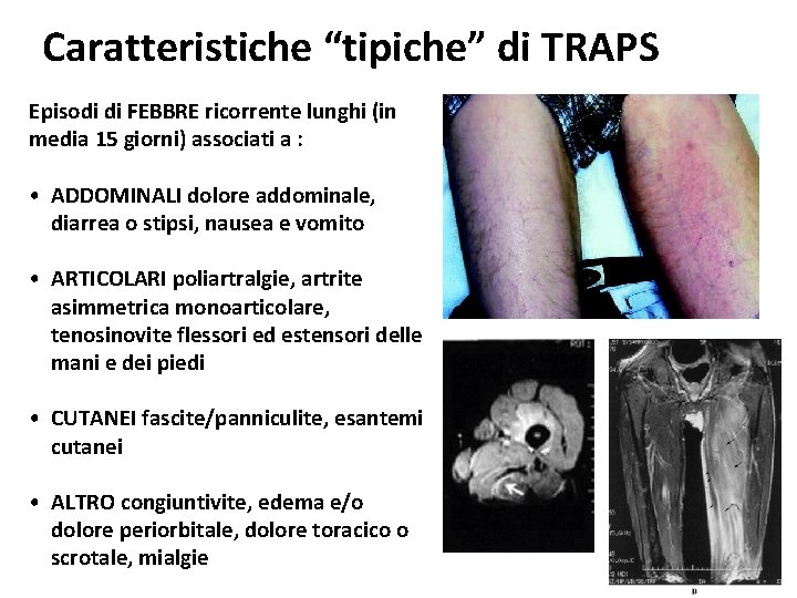 Caratteristiche “tipiche” di TRAPS Episodi di FEBBRE ricorrente lunghi (in media 15 giorni) associati