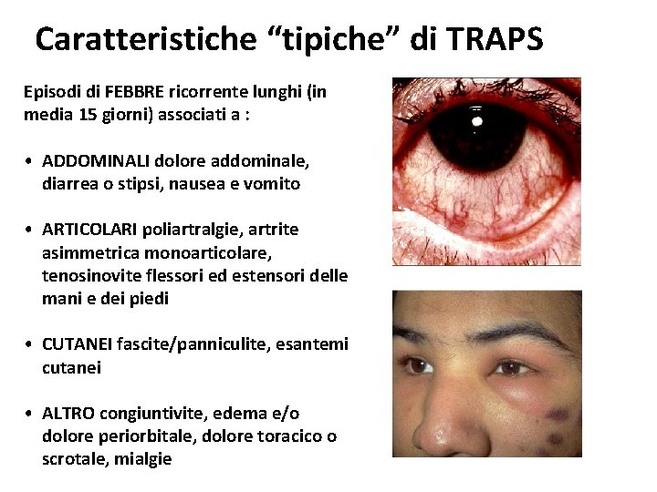 Caratteristiche “tipiche” di TRAPS Episodi di FEBBRE ricorrente lunghi (in media 15 giorni) associati