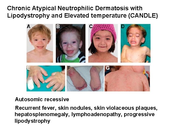 Chronic Atypical Neutrophilic Dermatosis with Lipodystrophy and Elevated temperature (CANDLE) Autosomic recessive Recurrent fever,