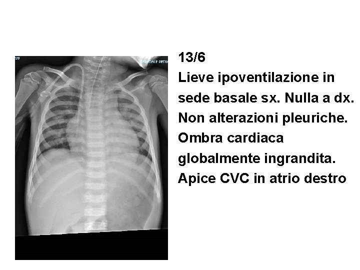 13/6 Lieve ipoventilazione in sede basale sx. Nulla a dx. Non alterazioni pleuriche. Ombra