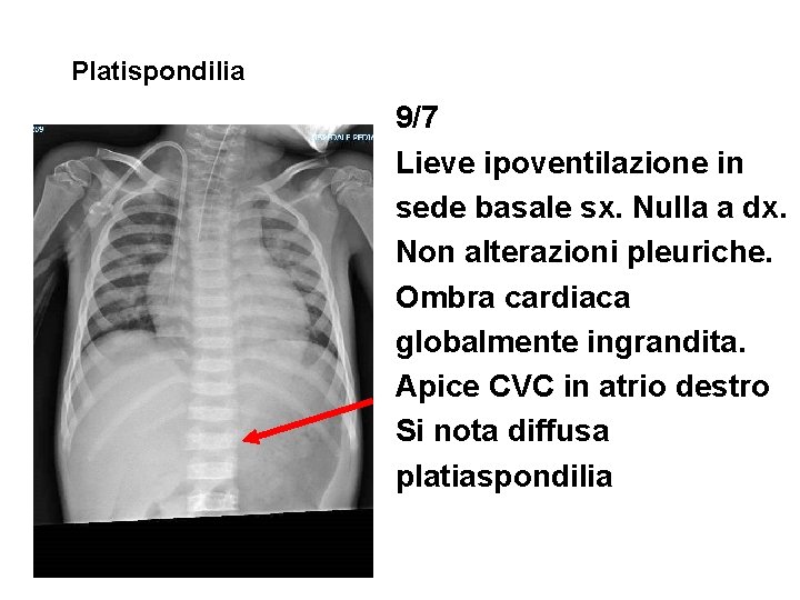 Platispondilia 9/7 Lieve ipoventilazione in sede basale sx. Nulla a dx. Non alterazioni pleuriche.