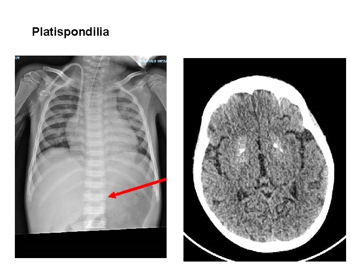 Platispondilia 