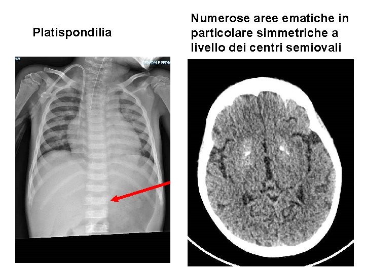 Platispondilia Numerose aree ematiche in particolare simmetriche a livello dei centri semiovali 