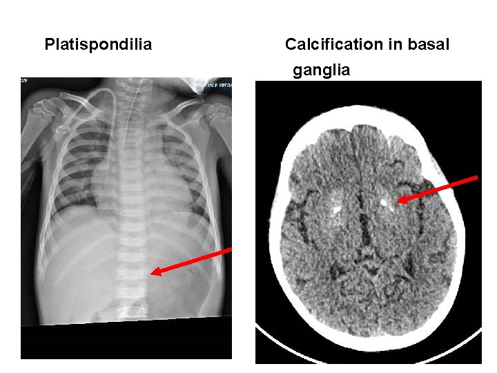 Platispondilia Calcification in basal ganglia 