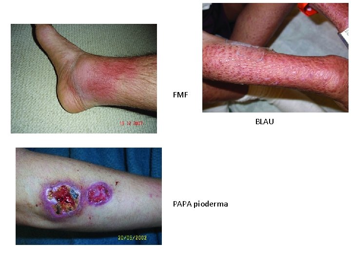 FMF BLAU PAPA pioderma 