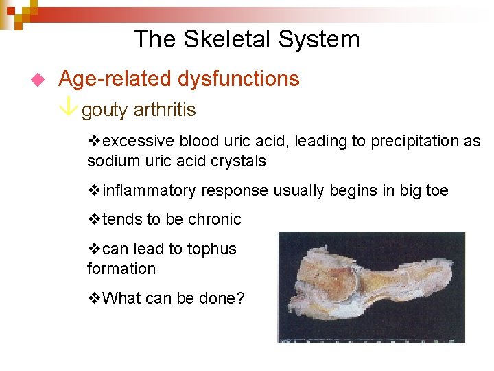 The Skeletal System u Age-related dysfunctions â gouty arthritis vexcessive blood uric acid, leading