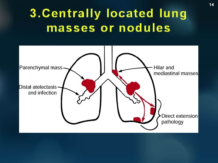 3. Centrally located lung masses or nodules 14 