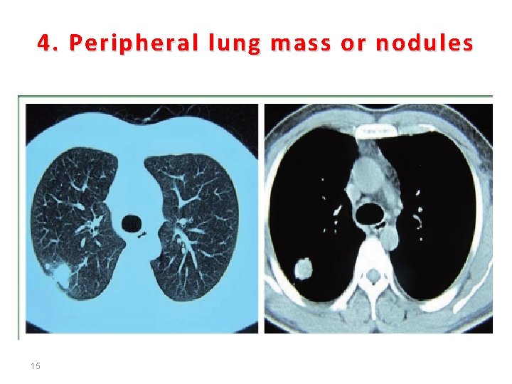 4. Peripheral lung mass or nodules 15 