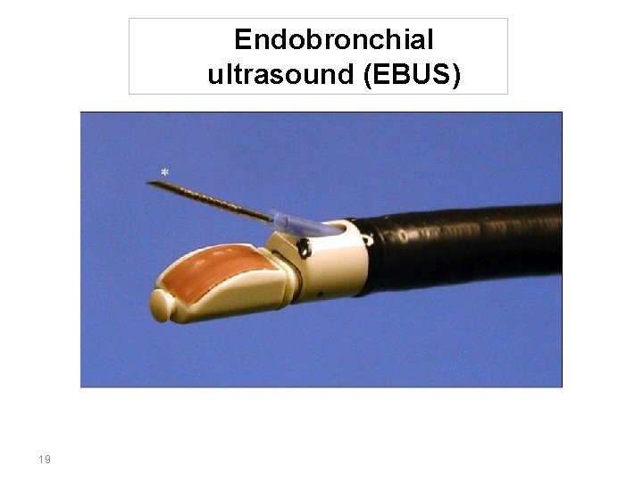 Endobronchial ultrasound (EBUS) 19 