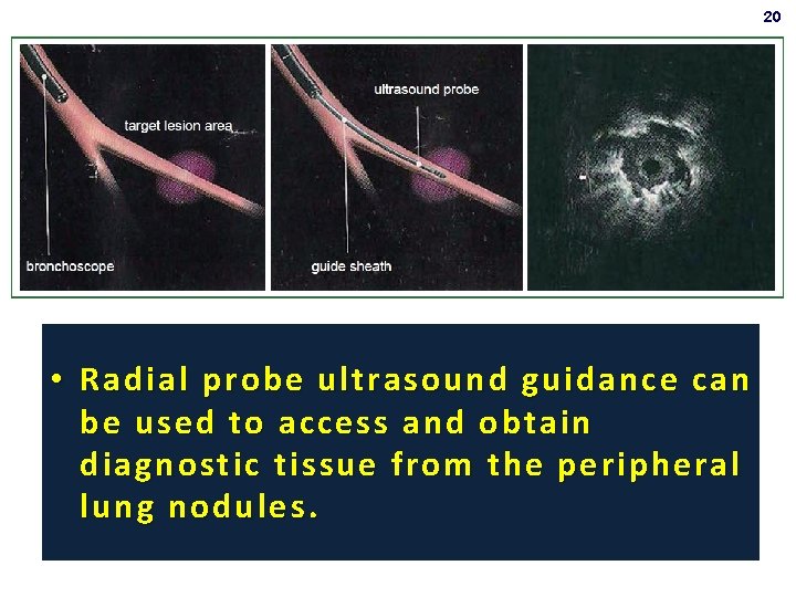 20 • Radial probe ultrasound guidance can be used to access and obtain diagnostic