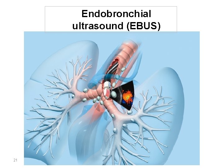 Endobronchial ultrasound (EBUS) 21 