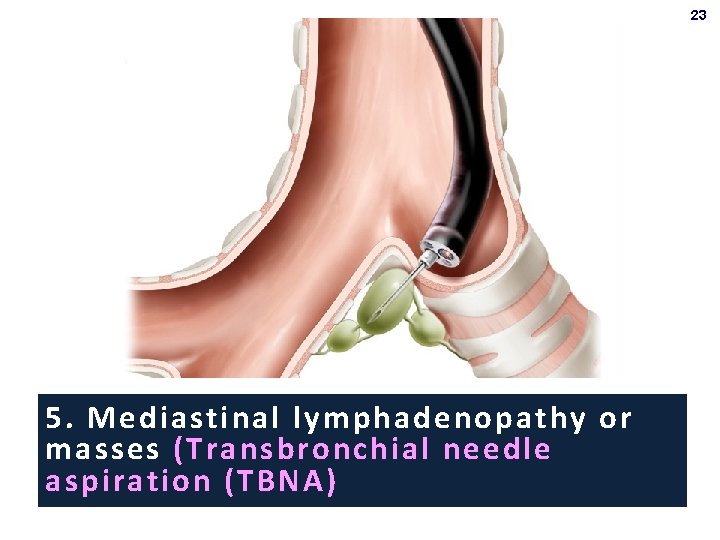 23 5. Mediastinal lymphadenopathy or masses (Transbronchial needle aspiration (TBNA) 