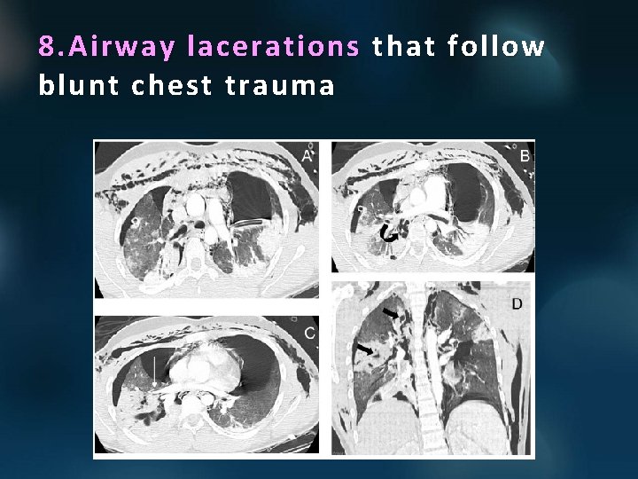 8. Airway lacerations that follow blunt chest trauma 