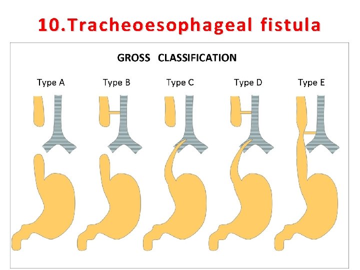 10. Tracheoesophageal fistula 28 