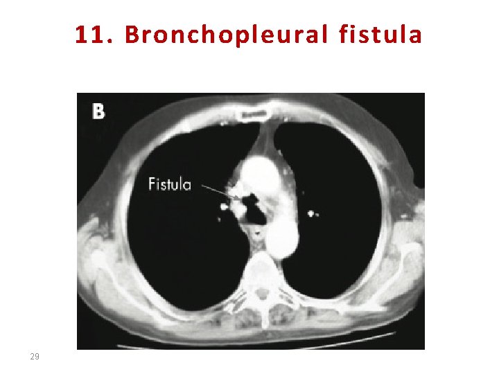 11. Bronchopleural fistula 29 
