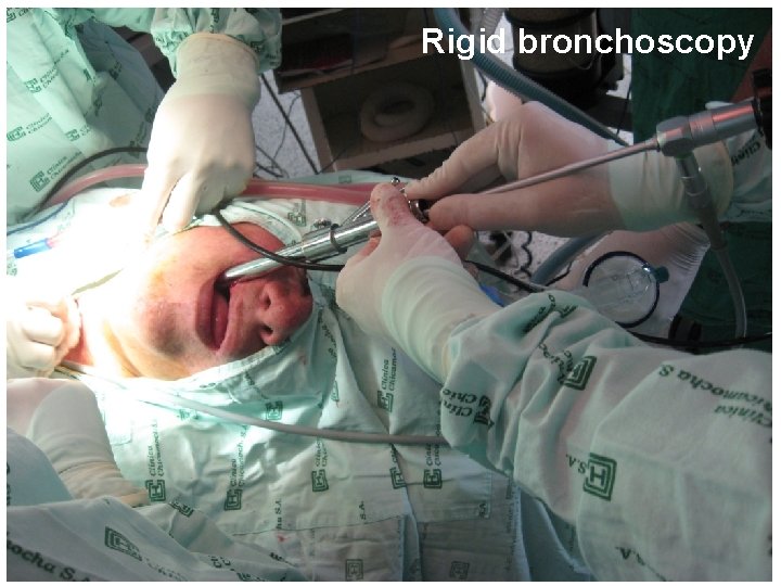 Rigid bronchoscopy 49 