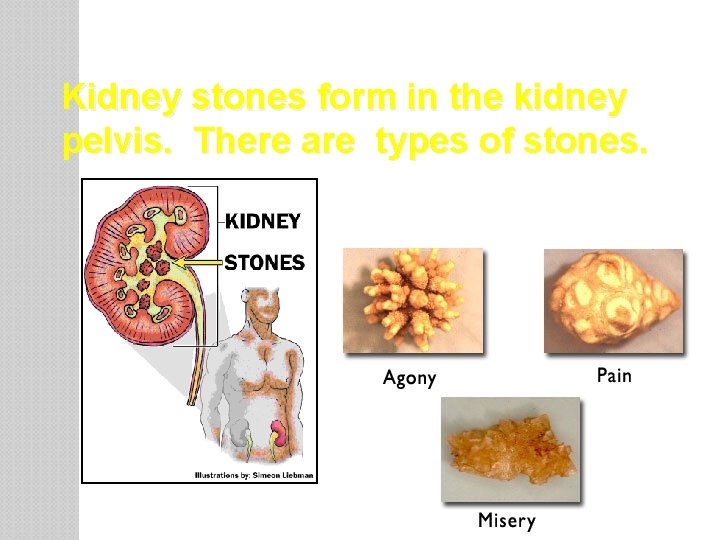Kidney stones form in the kidney pelvis. There are types of stones. • Calcium