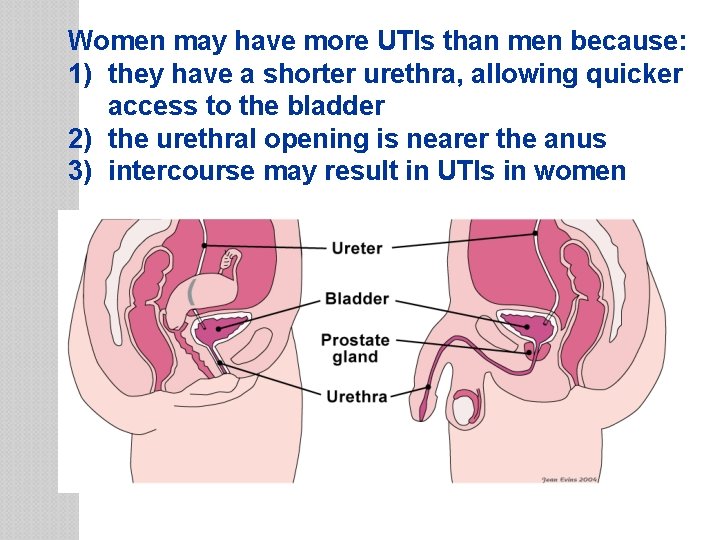 Women may have more UTIs than men because: 1) they have a shorter urethra,