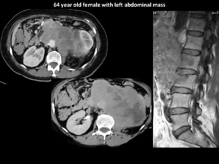 64 year old female with left abdominal mass 