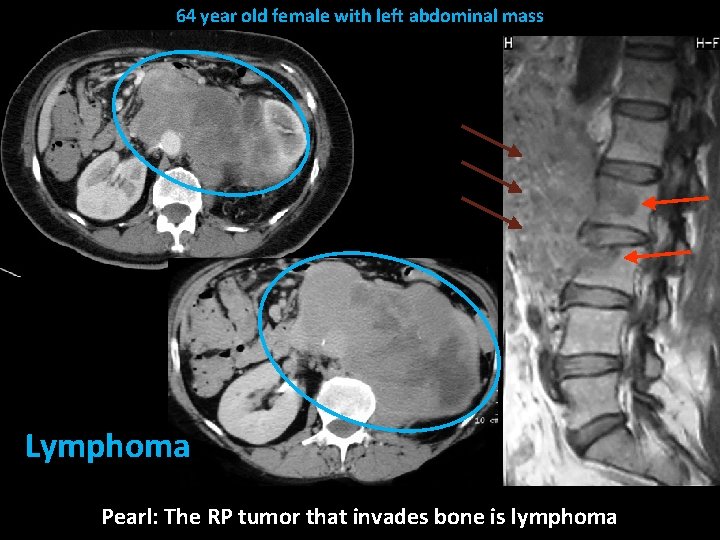 64 year old female with left abdominal mass Lymphoma Pearl: The RP tumor that