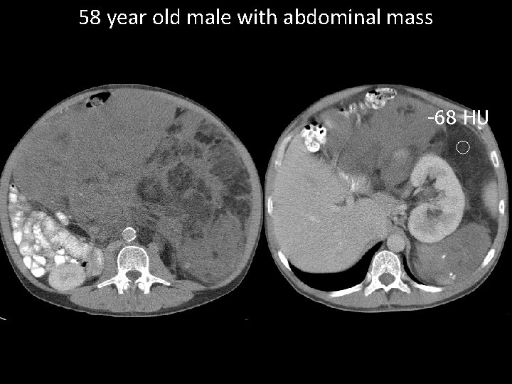 58 year old male with abdominal mass -68 HU 