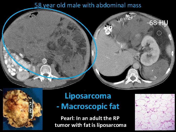 58 year old male with abdominal mass -68 HU Liposarcoma - Macroscopic fat Pearl: