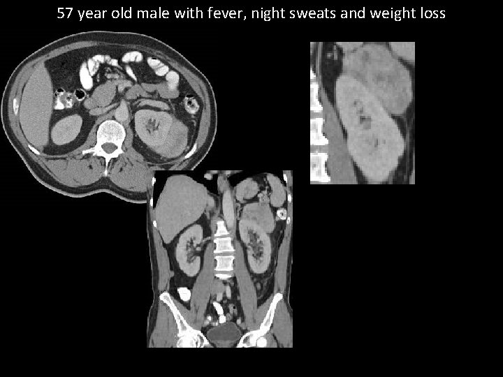 57 year old male with fever, night sweats and weight loss 
