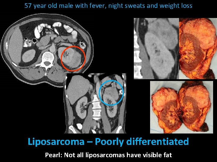 57 year old male with fever, night sweats and weight loss Liposarcoma – Poorly