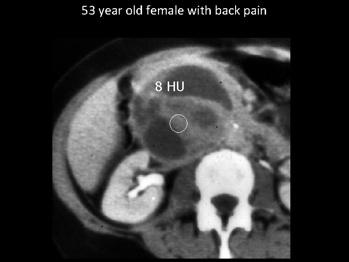 53 year old female with back pain 8 HU 